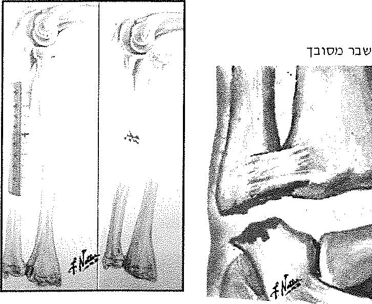 שבר מסובך, שבר פשוט